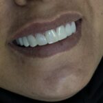 کامپوزیت زیبایی