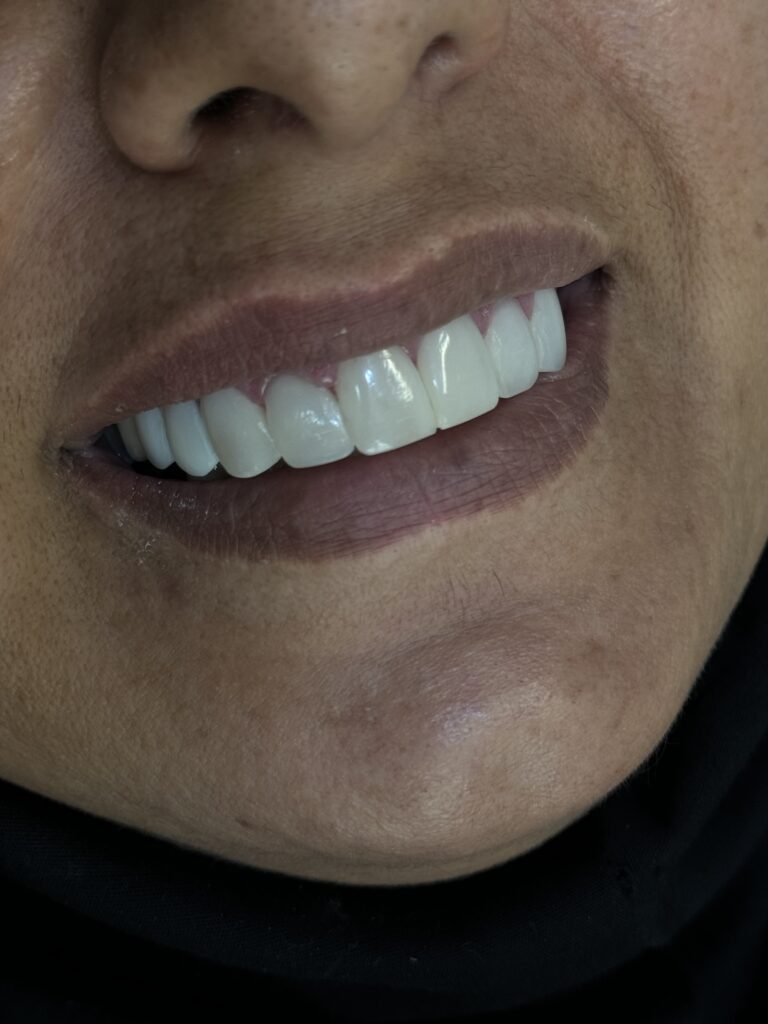 کامپوزیت زیبایی